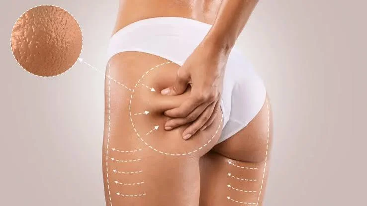 Tratamento corporal para celulite