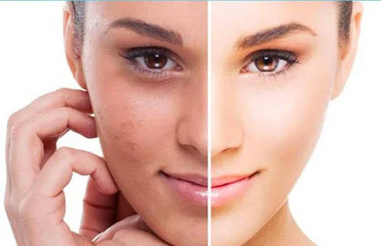 Clareamento Facial