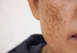 Como as Enzimas Podem Transformar o Melasma